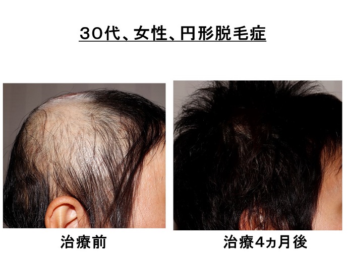 円形脱毛症　病院